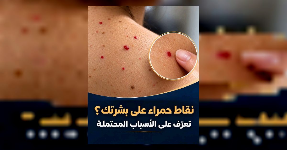 أسبـ.ـاب ظهور نقاط حمـ.ـراء على بشرتك.. الطبيب يكشف معناها المحتمل سأعطـ.ـيك التفـ.ـاصيل مقـ.ـابل كلـ.ـمة “تم”وشـ.ـاهد أول تعـ.ـليق