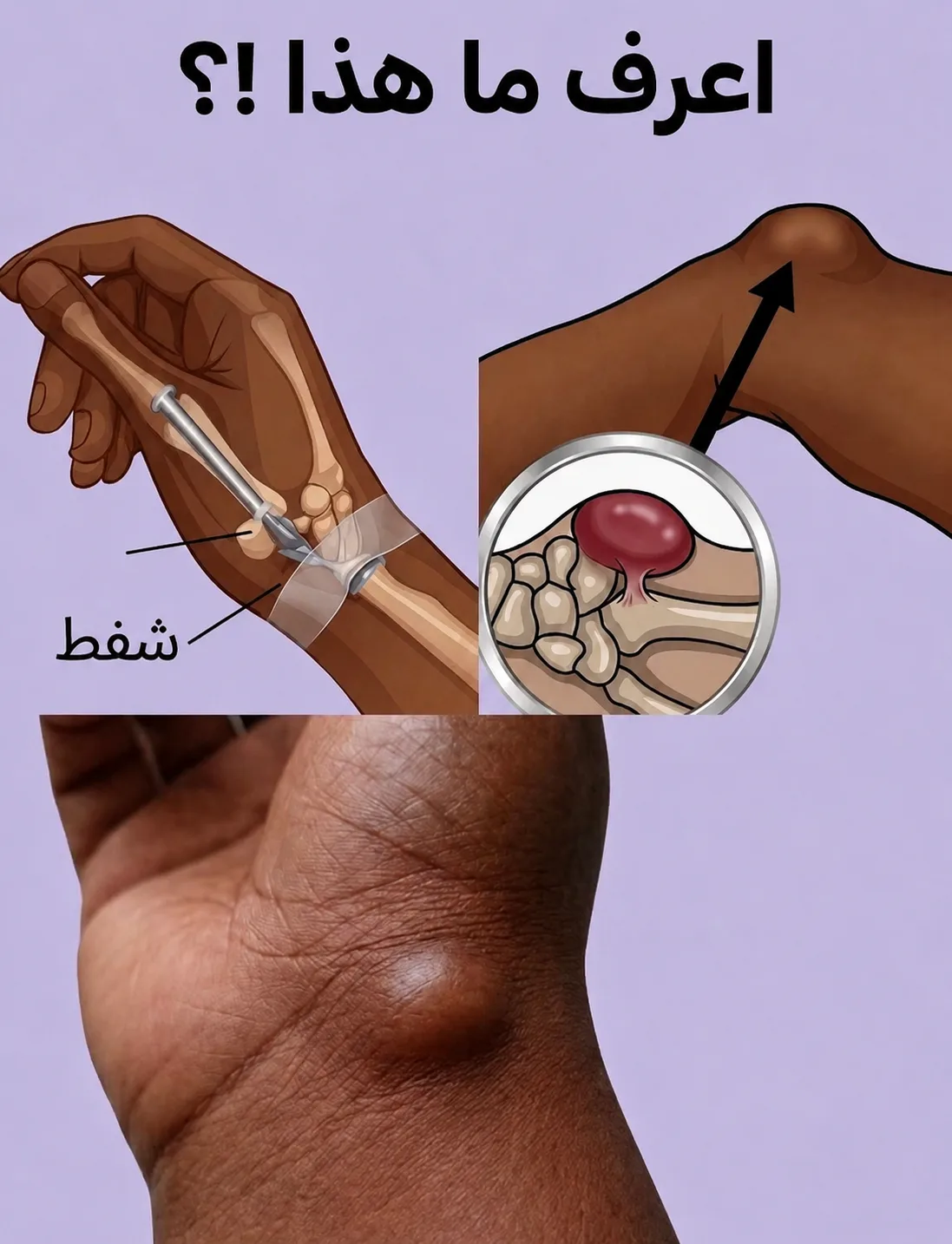 الكيس الزليـ.ـلي (الور،م العُقدي)